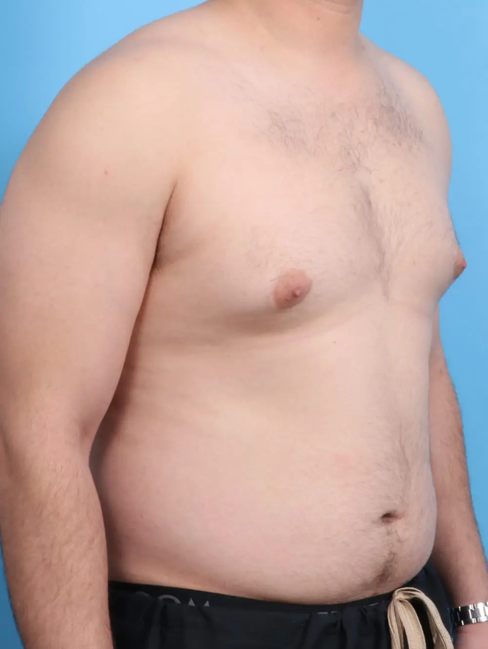 Gynecomastia Patient Photo - Case 19831 - before view-1