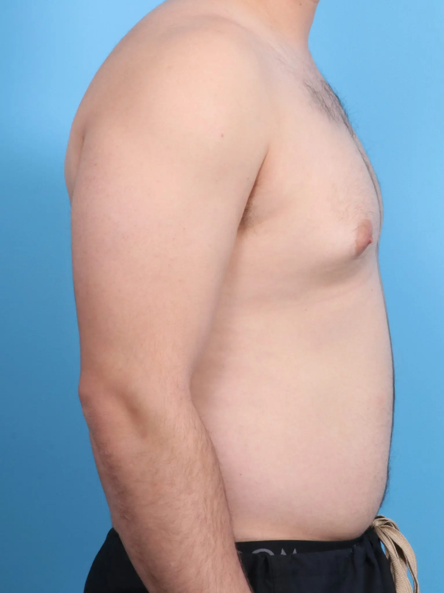 Gynecomastia Patient Photo - Case 19831 - before view-2