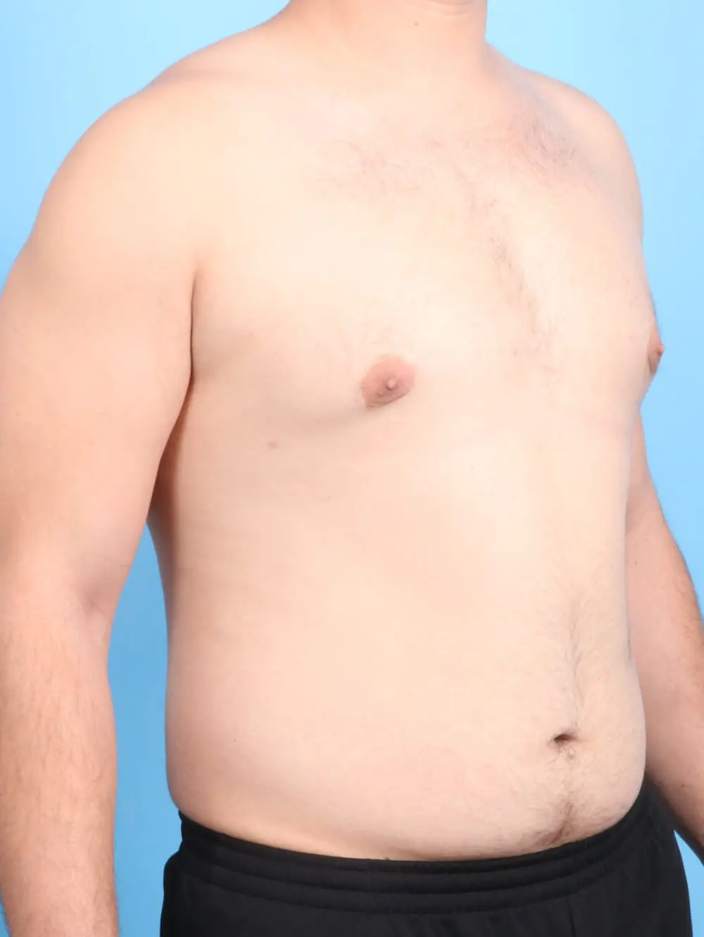 Gynecomastia Patient Photo - Case 19831 - after view-1
