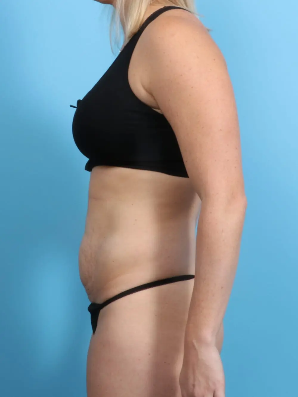 Tummy Tuck Patient Photo - Case 19846 - before view-2