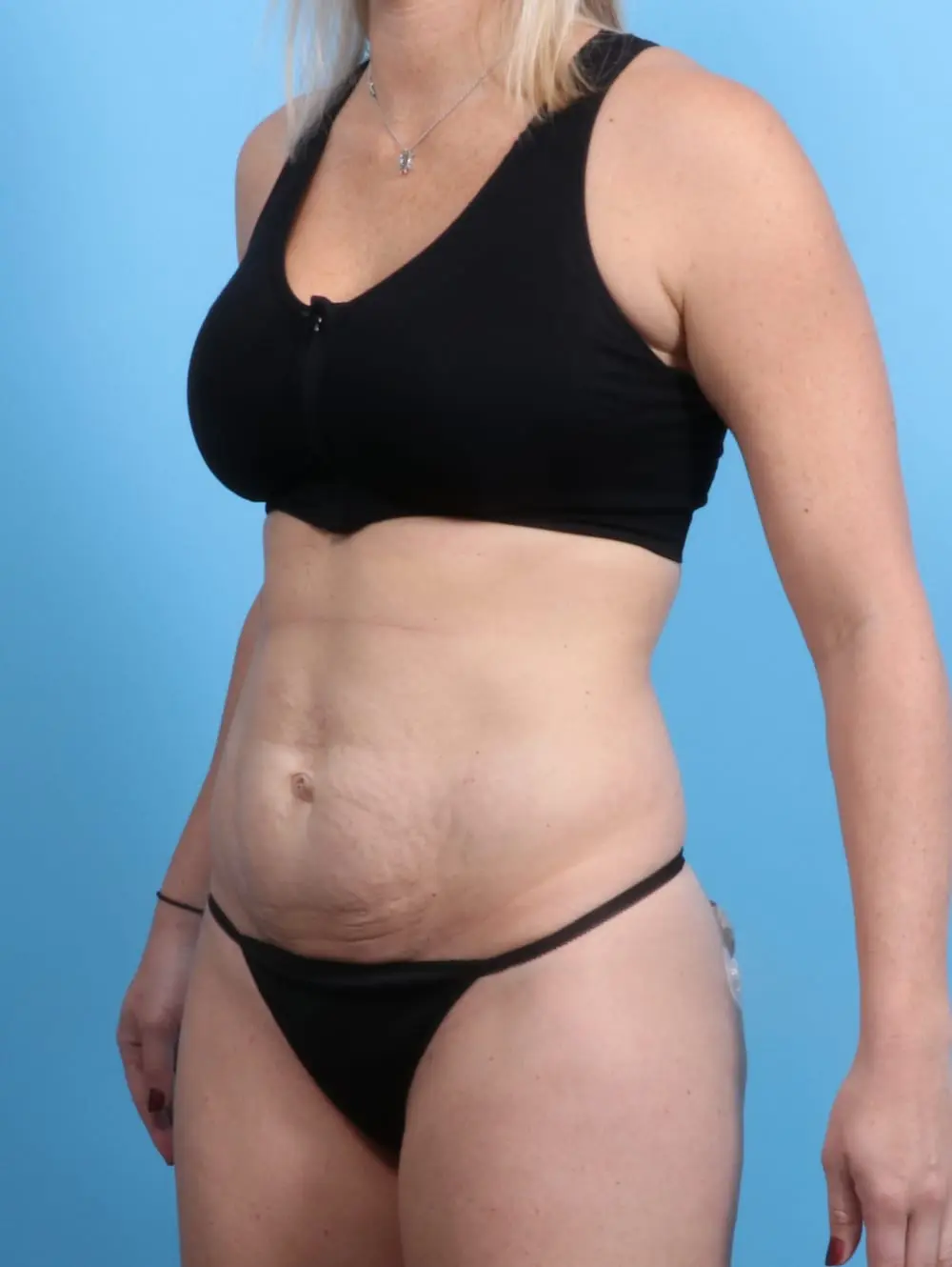 Tummy Tuck Patient Photo - Case 19846 - before view-1