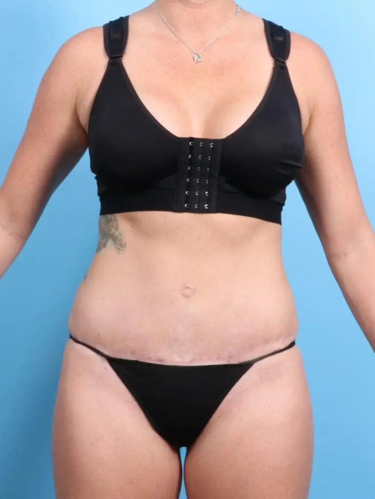 Tummy Tuck - Case 19846 - After