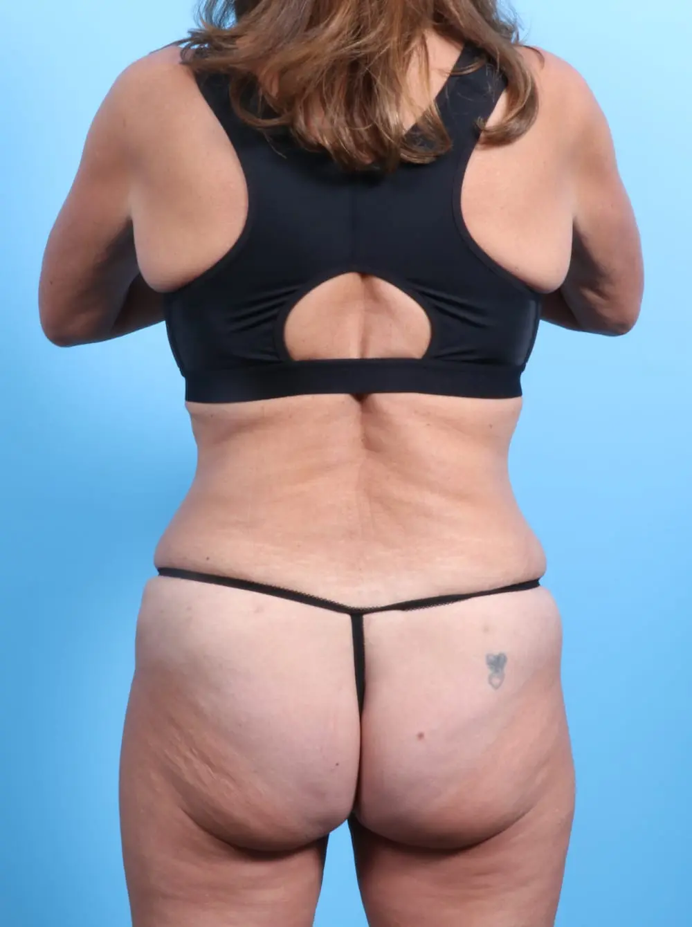 Tummy Tuck Patient Photo - Case 19865 - after view-3