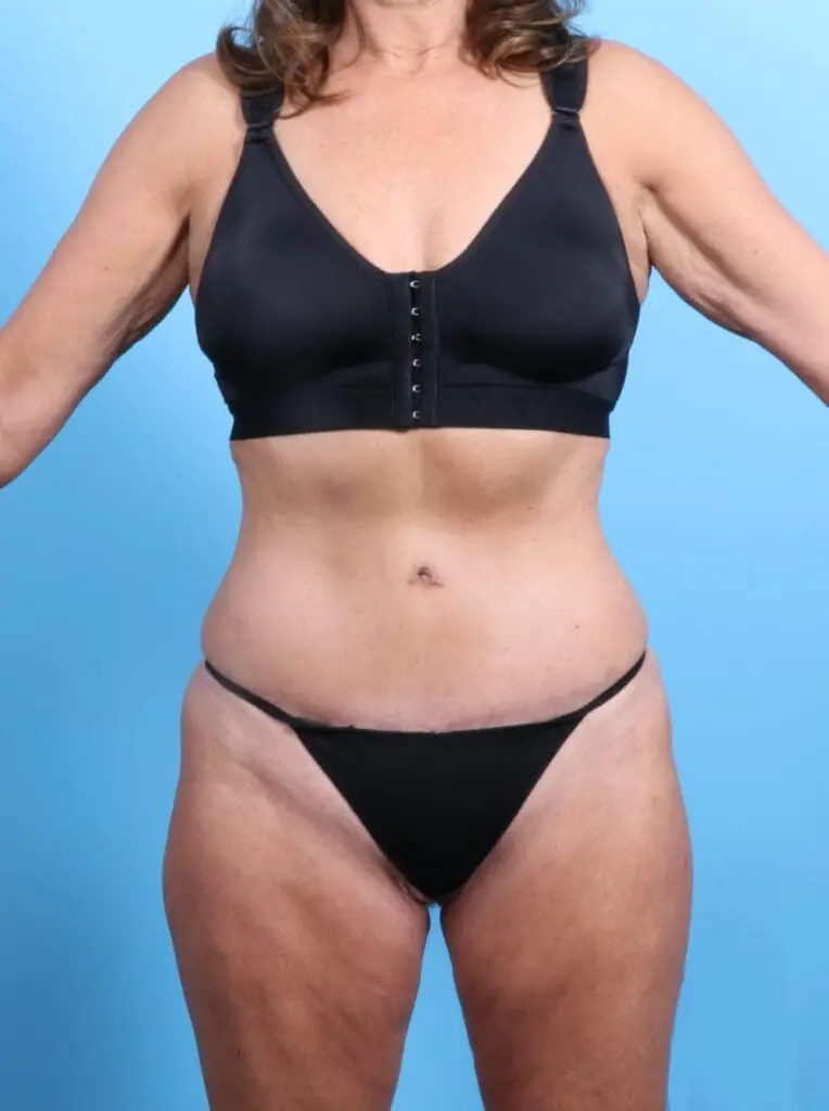 Tummy Tuck - Case 19865 - After