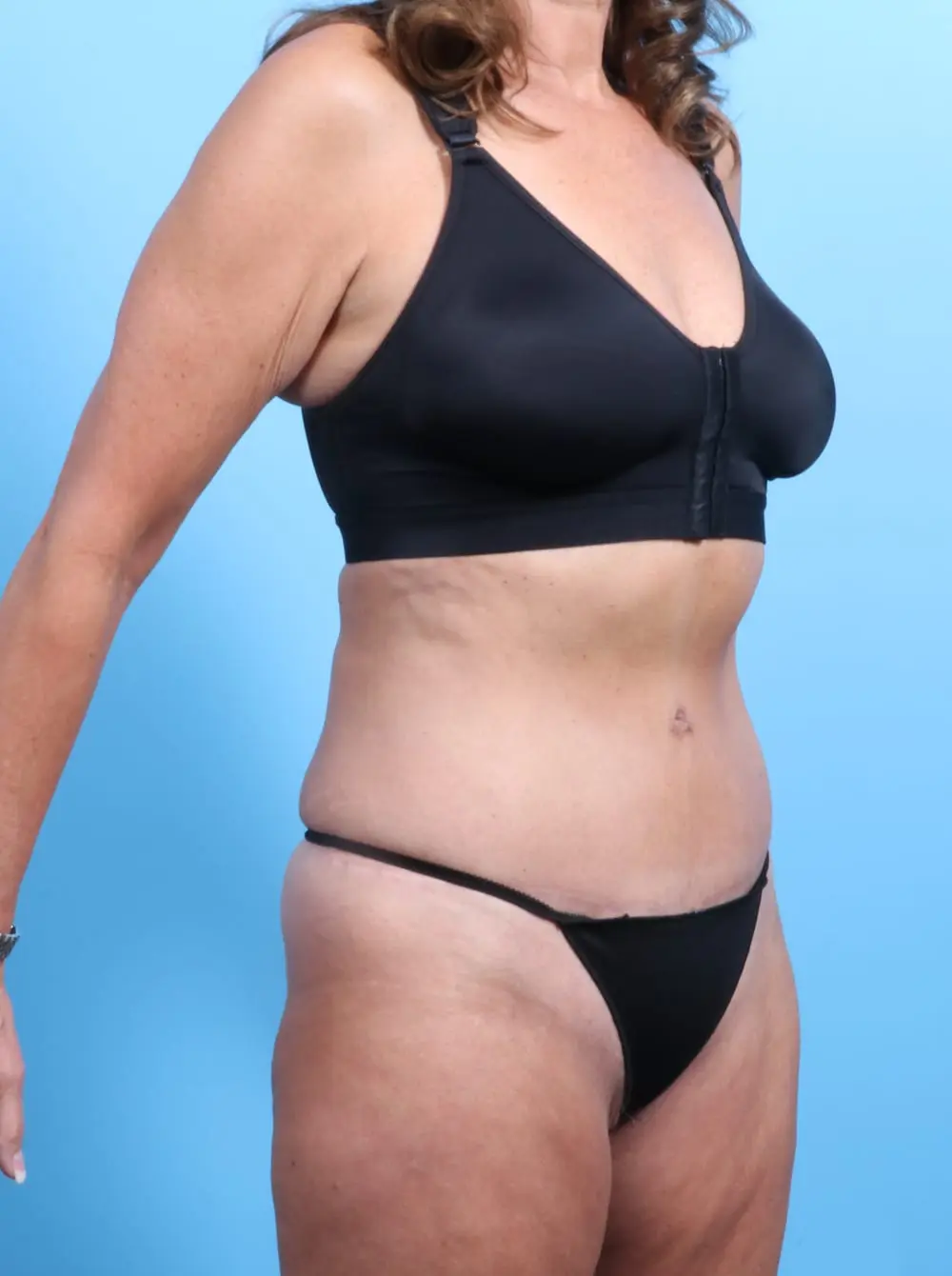 Tummy Tuck Patient Photo - Case 19865 - after view-1