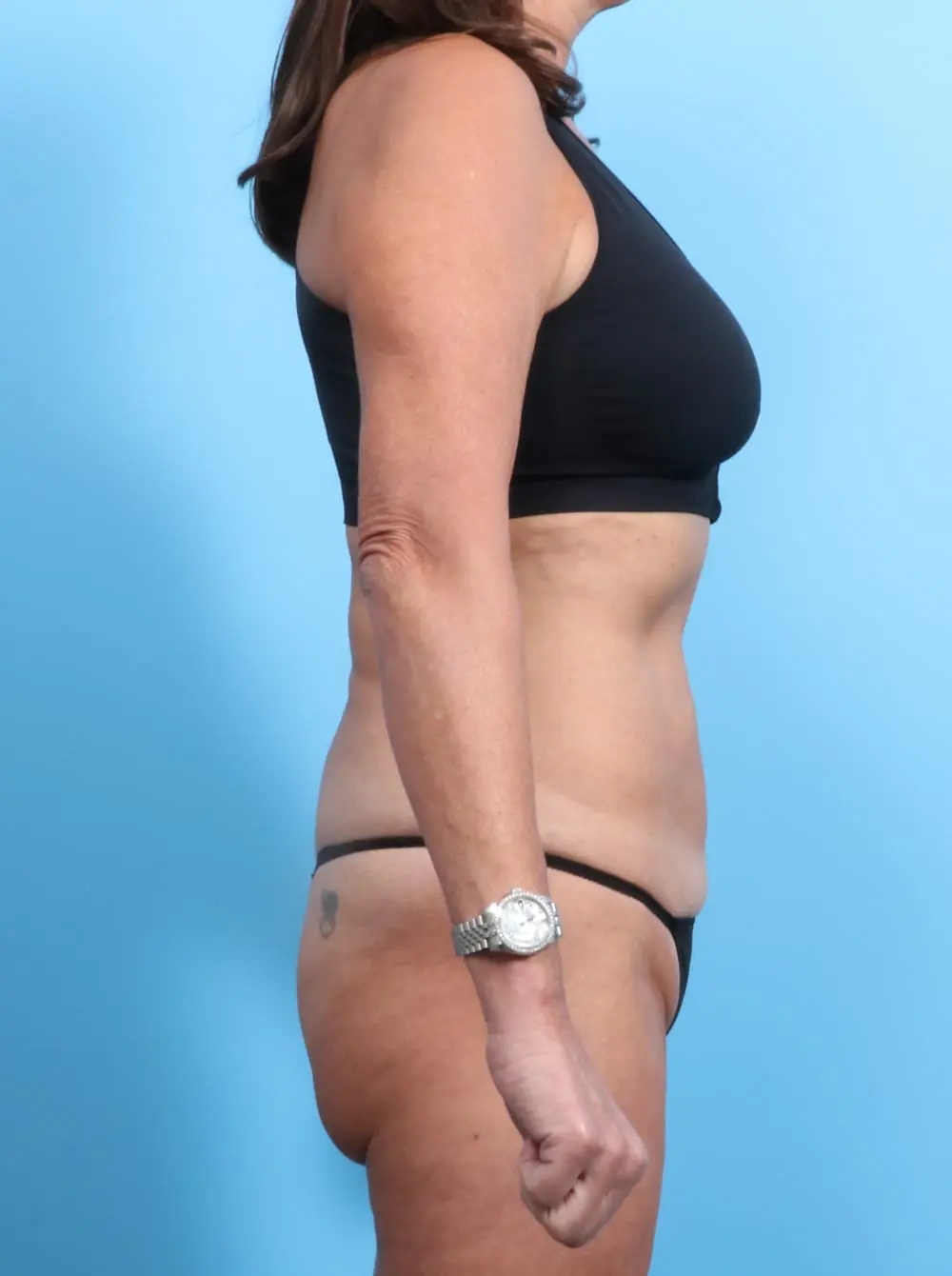 Tummy Tuck Patient Photo - Case 19865 - before view-2