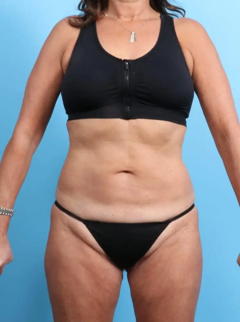 Tummy Tuck - Case 19865 - Before