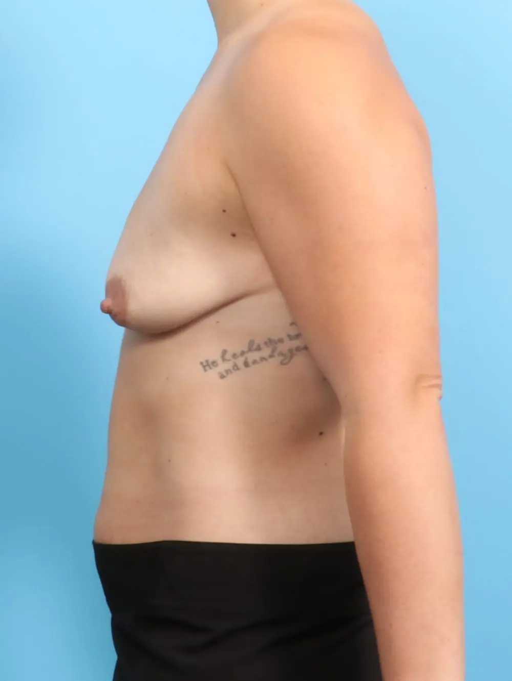 Breast Lift/Reduction with Implants Patient Photo - Case 19897 - before view-2