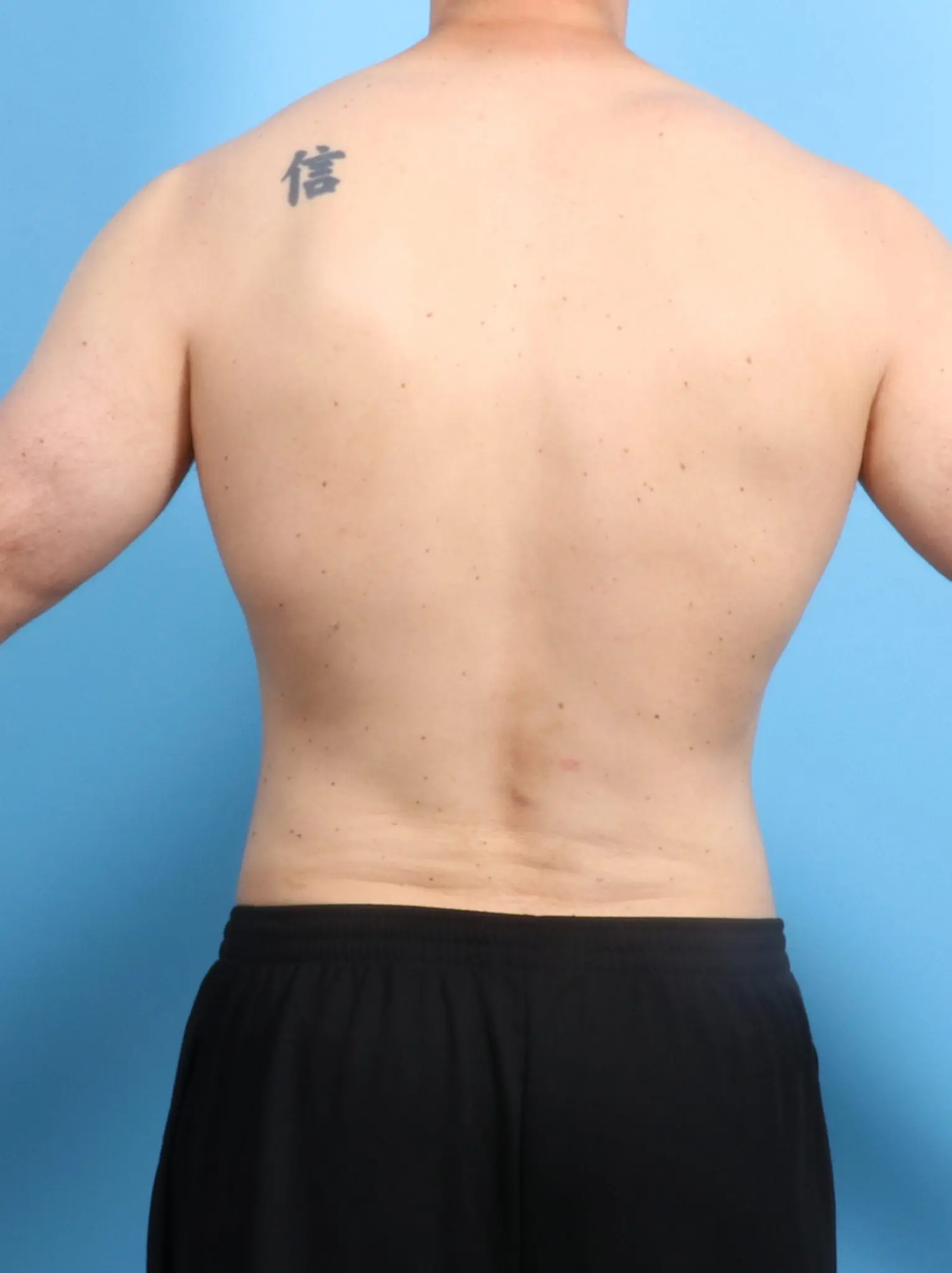 Male Liposuction Patient Photo - Case 19905 - after view-3
