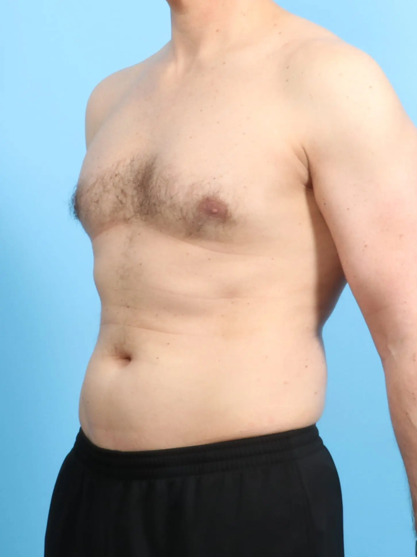 Male Liposuction Patient Photo - Case 19905 - before view-1
