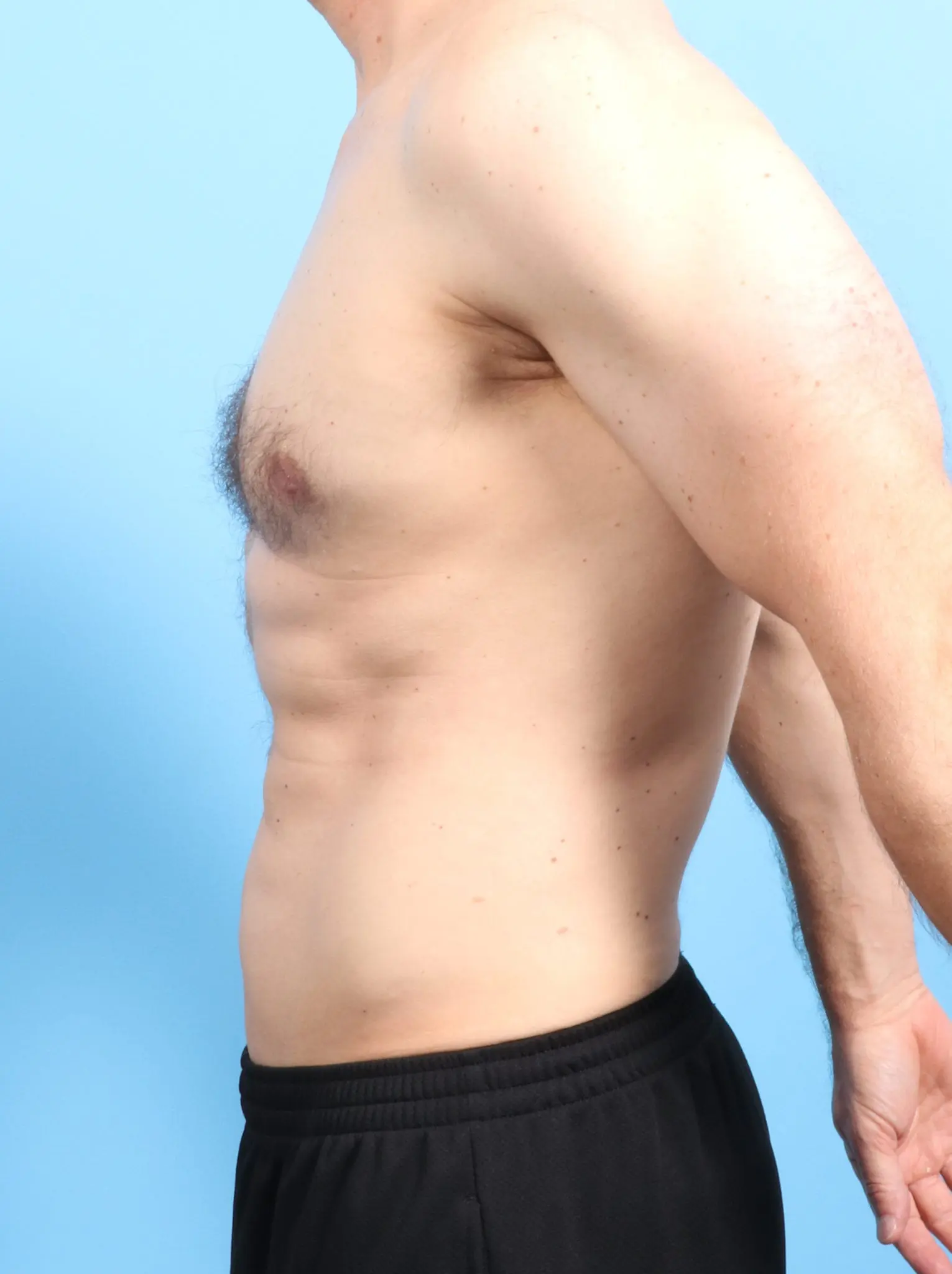 Male Liposuction Patient Photo - Case 19905 - after view-2