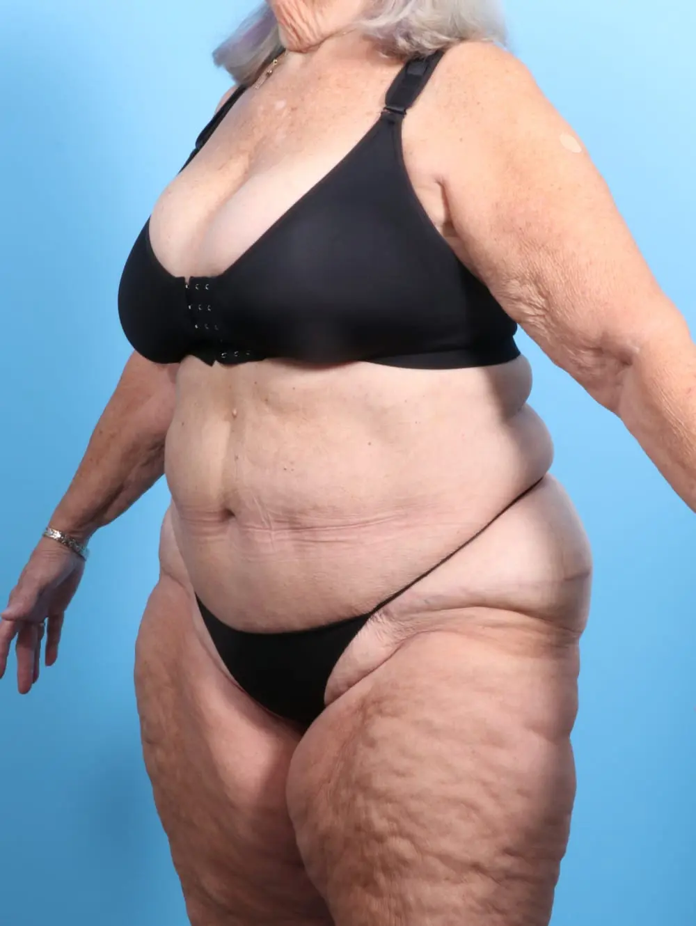 Tummy Tuck Patient Photo - Case 19916 - after view-1