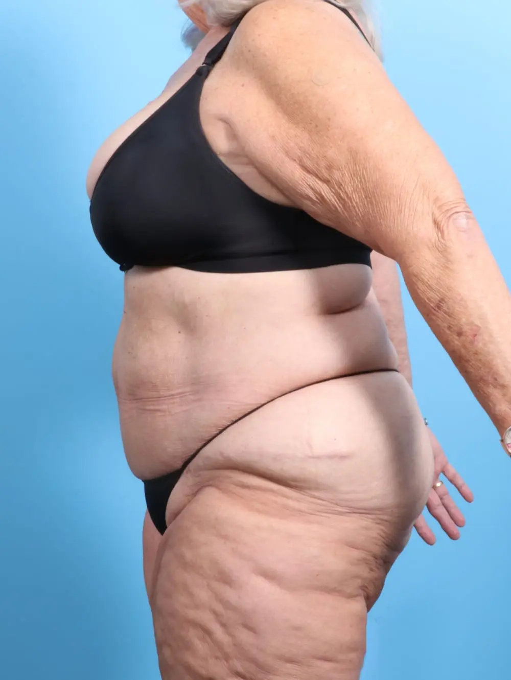 Tummy Tuck Patient Photo - Case 19916 - after view-2