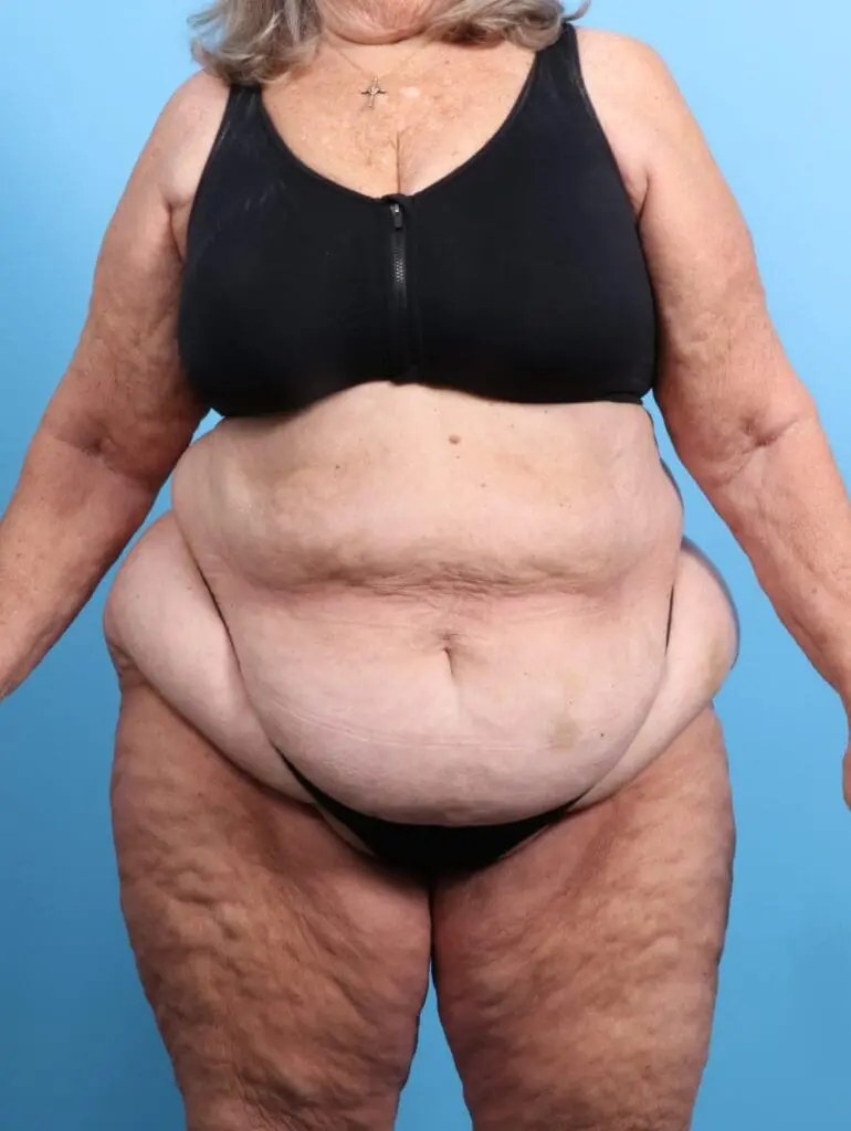 Tummy Tuck - Case 19916 - Before