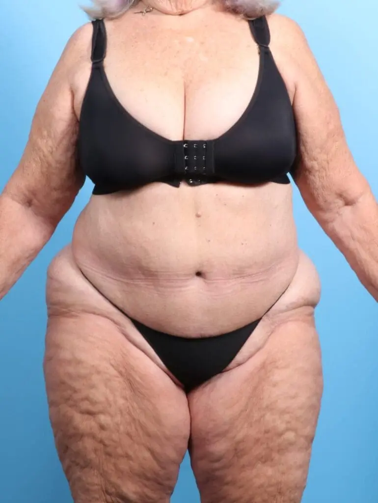 Tummy Tuck - Case 19916 - After