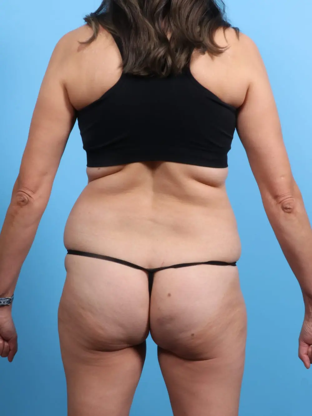 Tummy Tuck Patient Photo - Case 19934 - before view-4