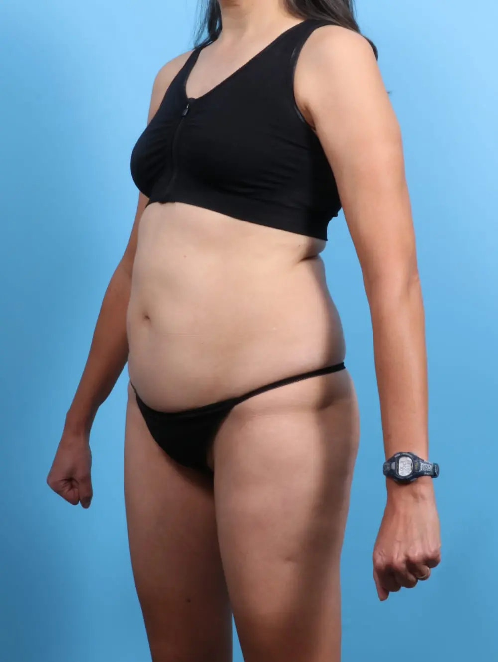 Tummy Tuck Patient Photo - Case 19934 - before view-1