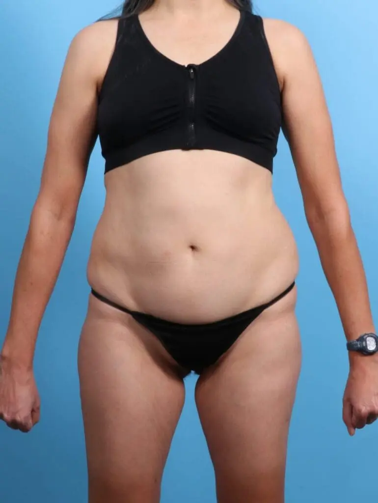 Tummy Tuck - Case 19934 - Before