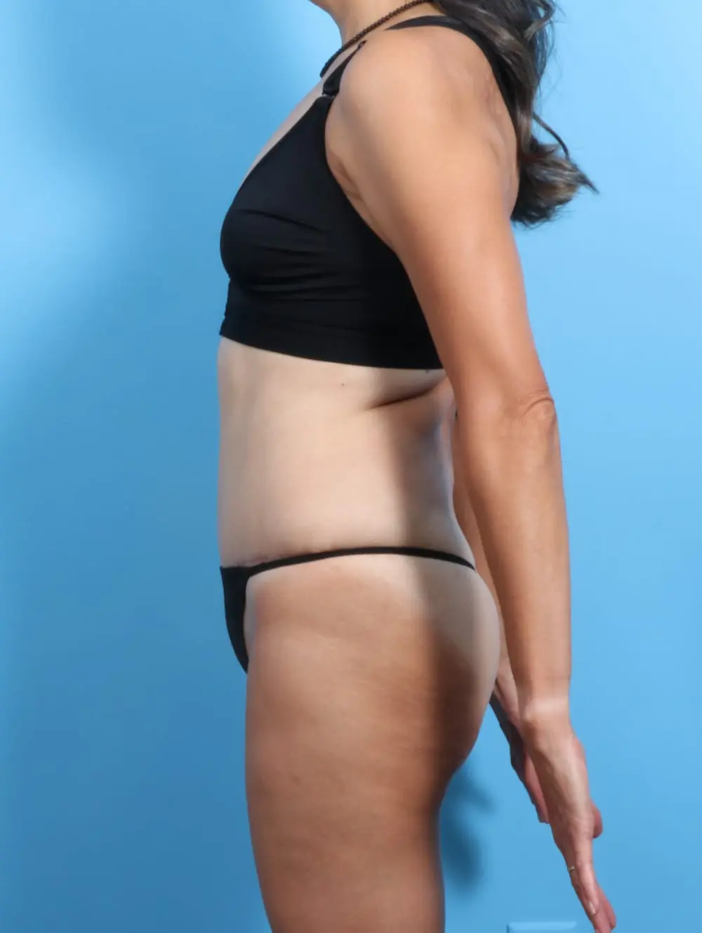 Tummy Tuck Patient Photo - Case 19934 - after view-2
