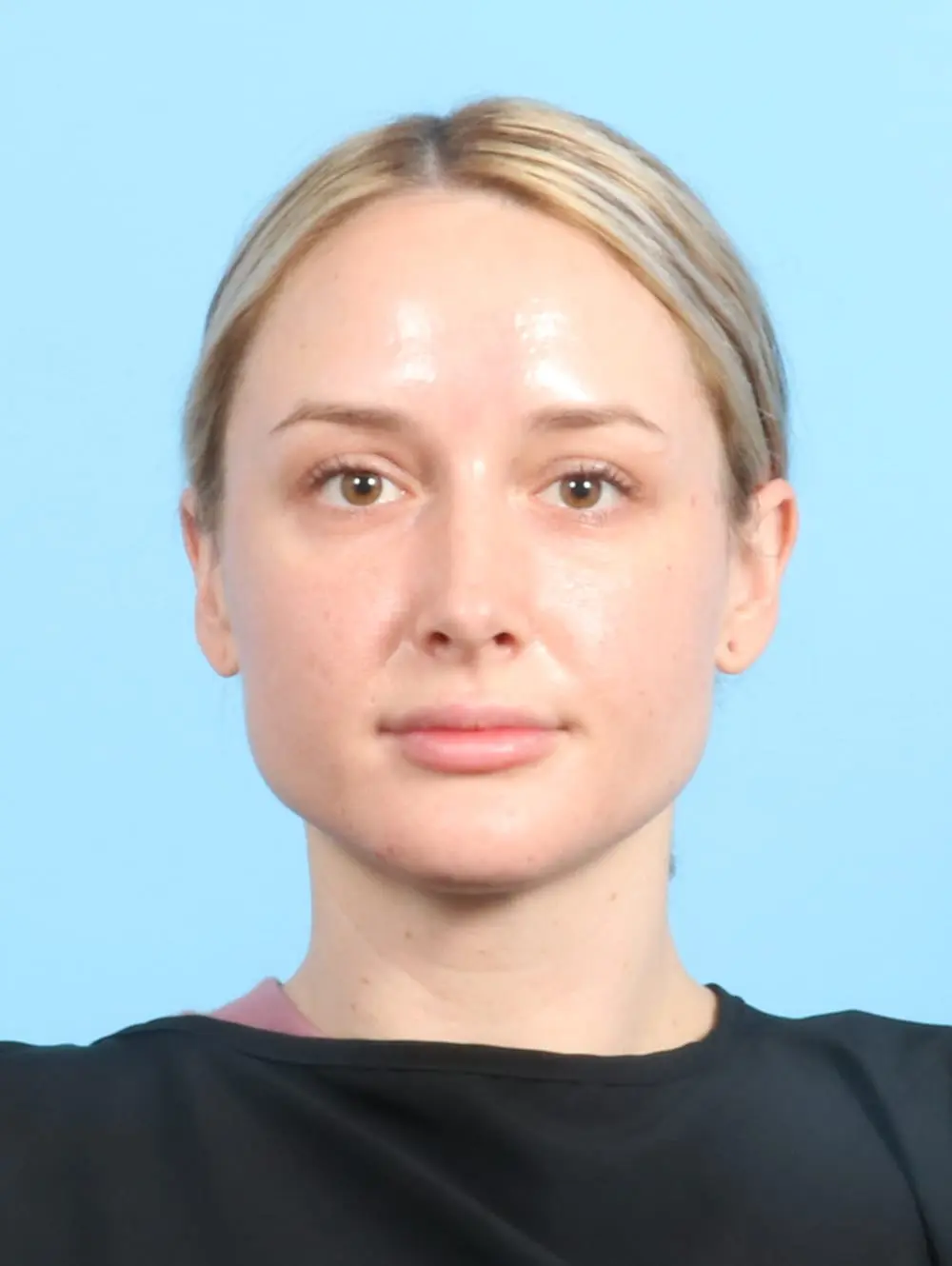 Rhinoplasty Patient Photo - Case 19955 - after view-2