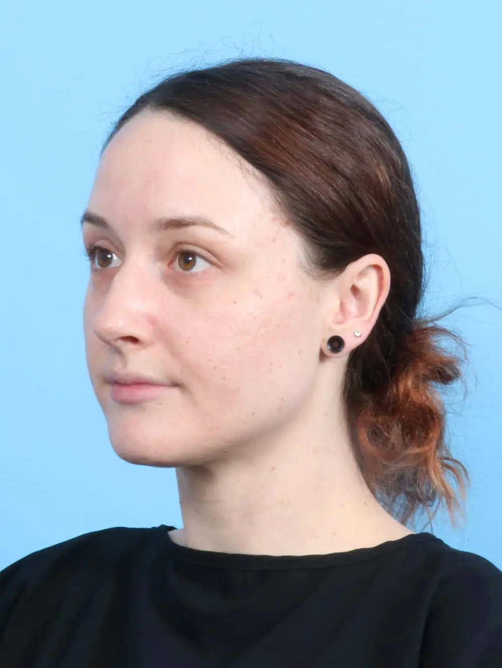 Rhinoplasty Patient Photo - Case 19955 - before view-1