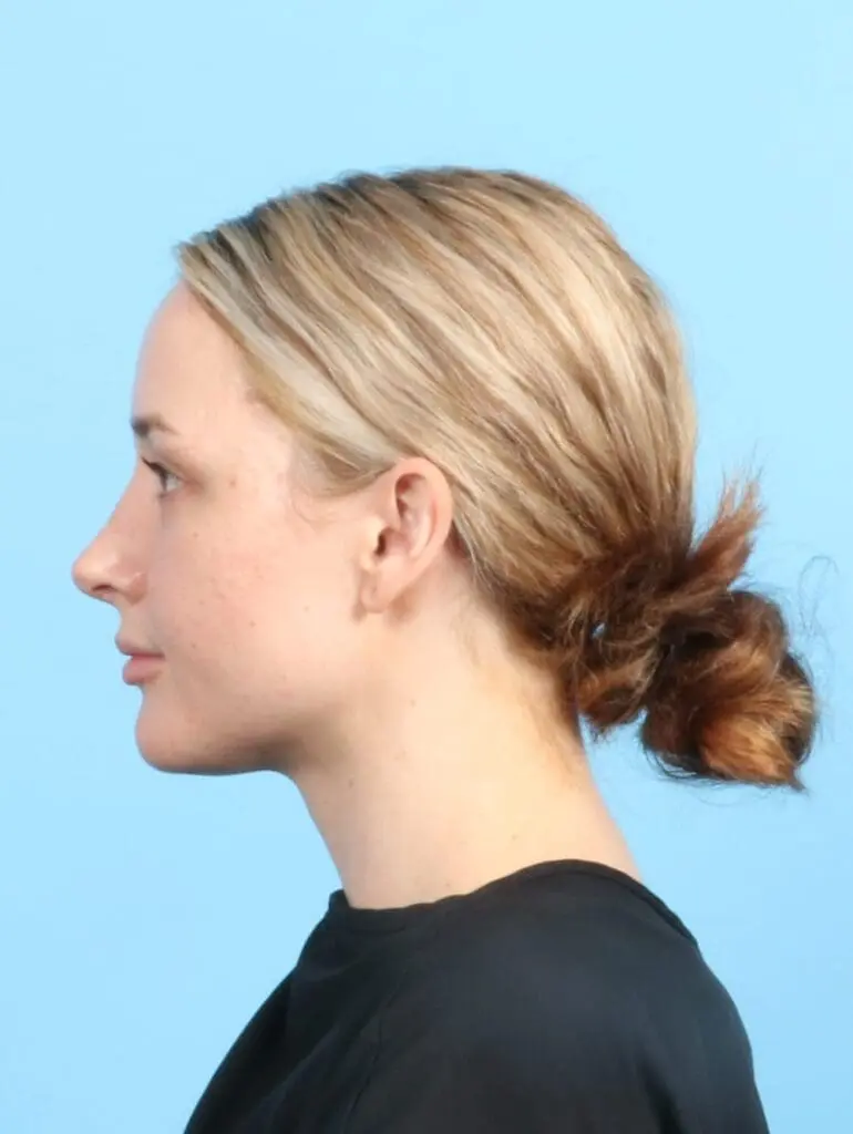 Rhinoplasty - Case 19955 - After