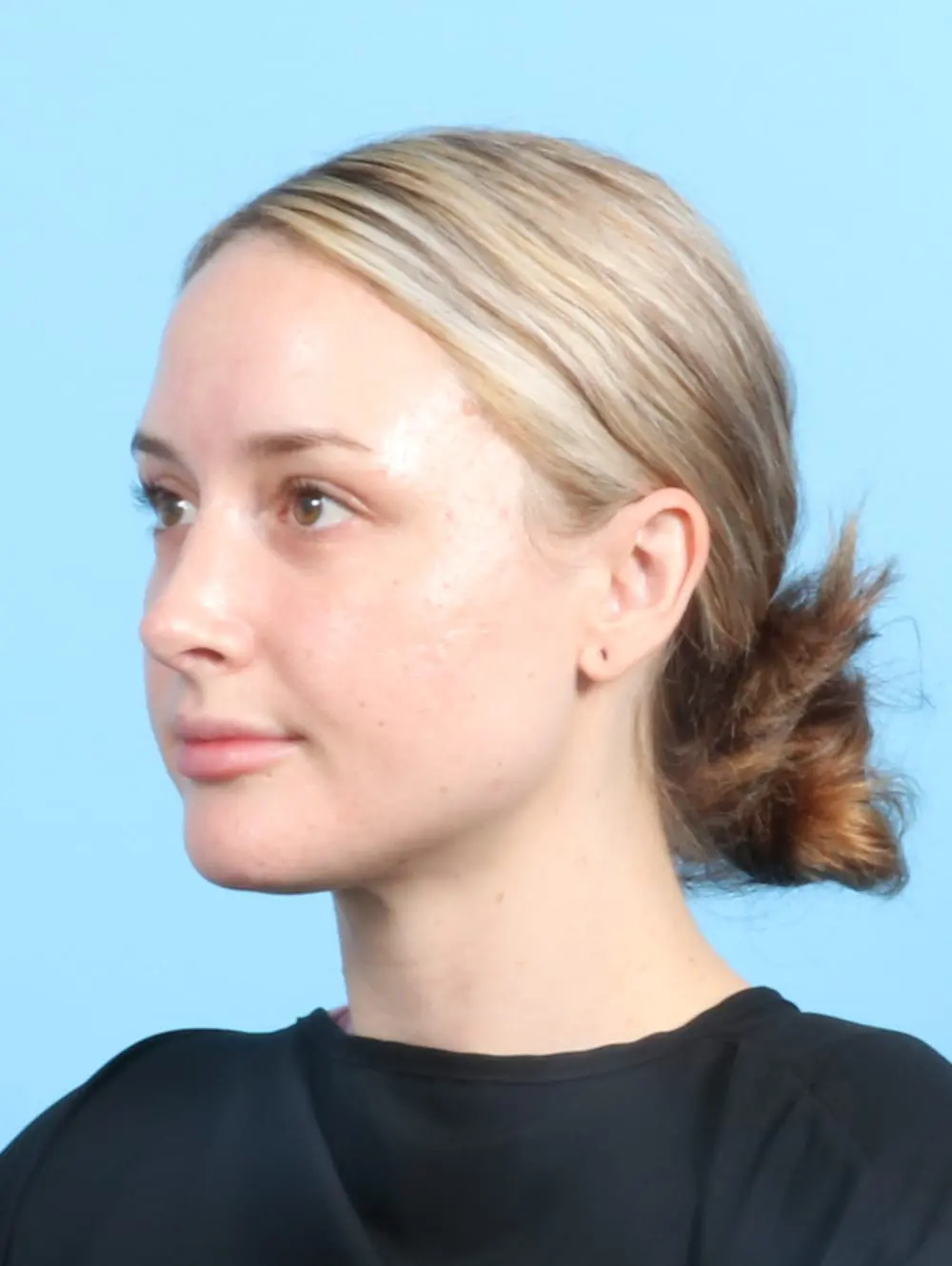 Rhinoplasty Patient Photo - Case 19955 - after view-1