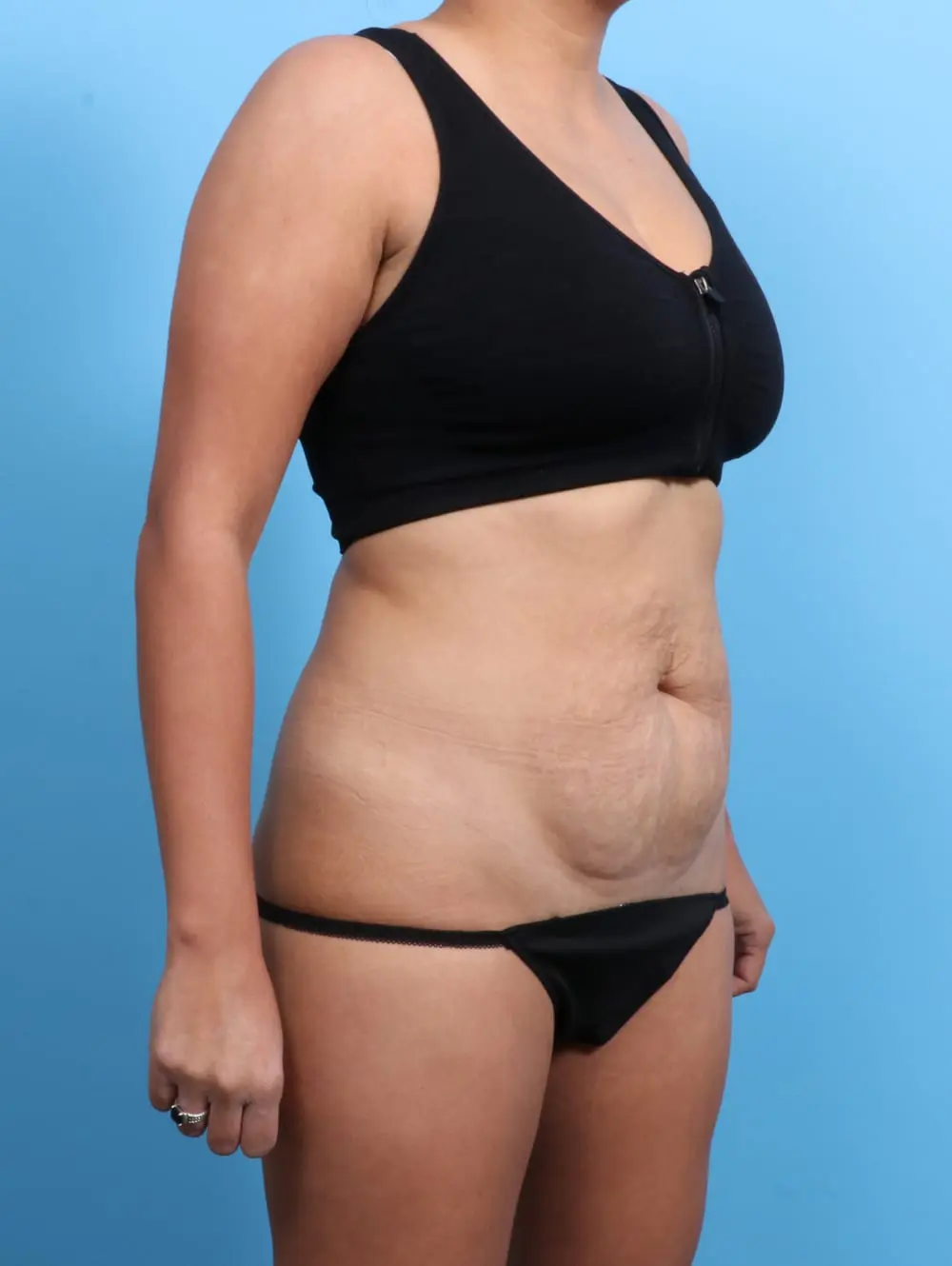 Tummy Tuck Patient Photo - Case 19991 - before view-1