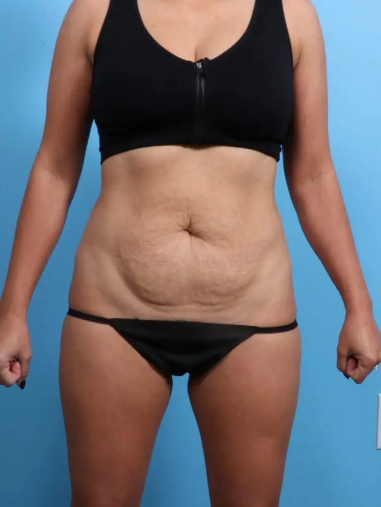 Tummy Tuck - Case 19991 - Before