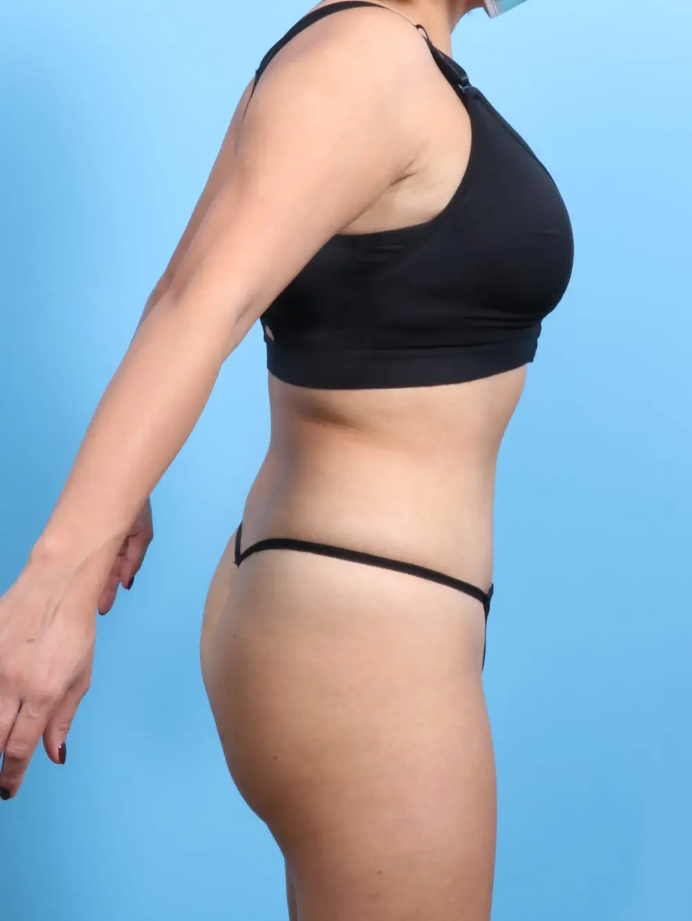 Tummy Tuck Patient Photo - Case 19991 - after view-2