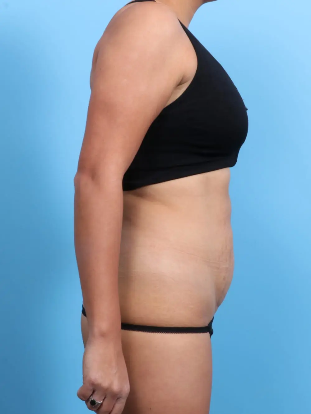 Tummy Tuck Patient Photo - Case 19991 - before view-2