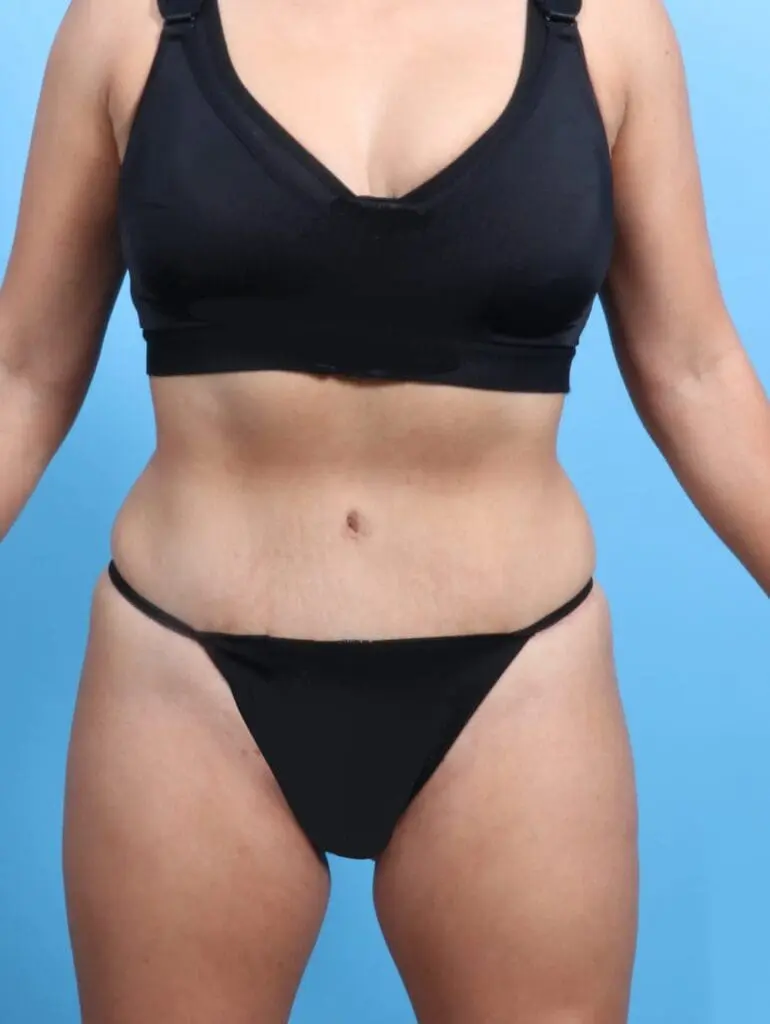 Tummy Tuck - Case 19991 - After