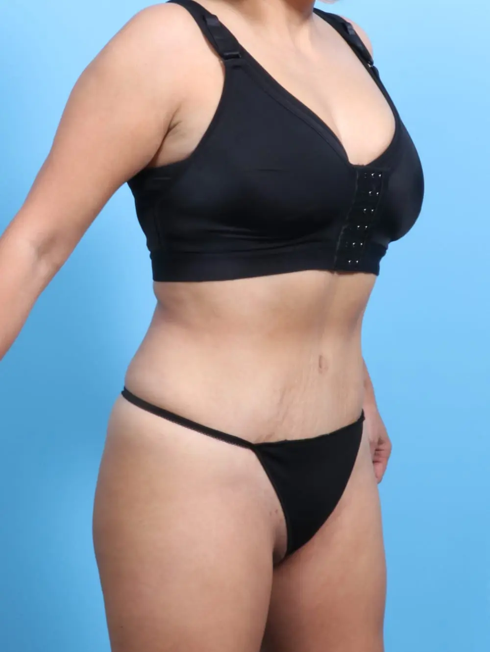 Tummy Tuck Patient Photo - Case 19991 - after view-1