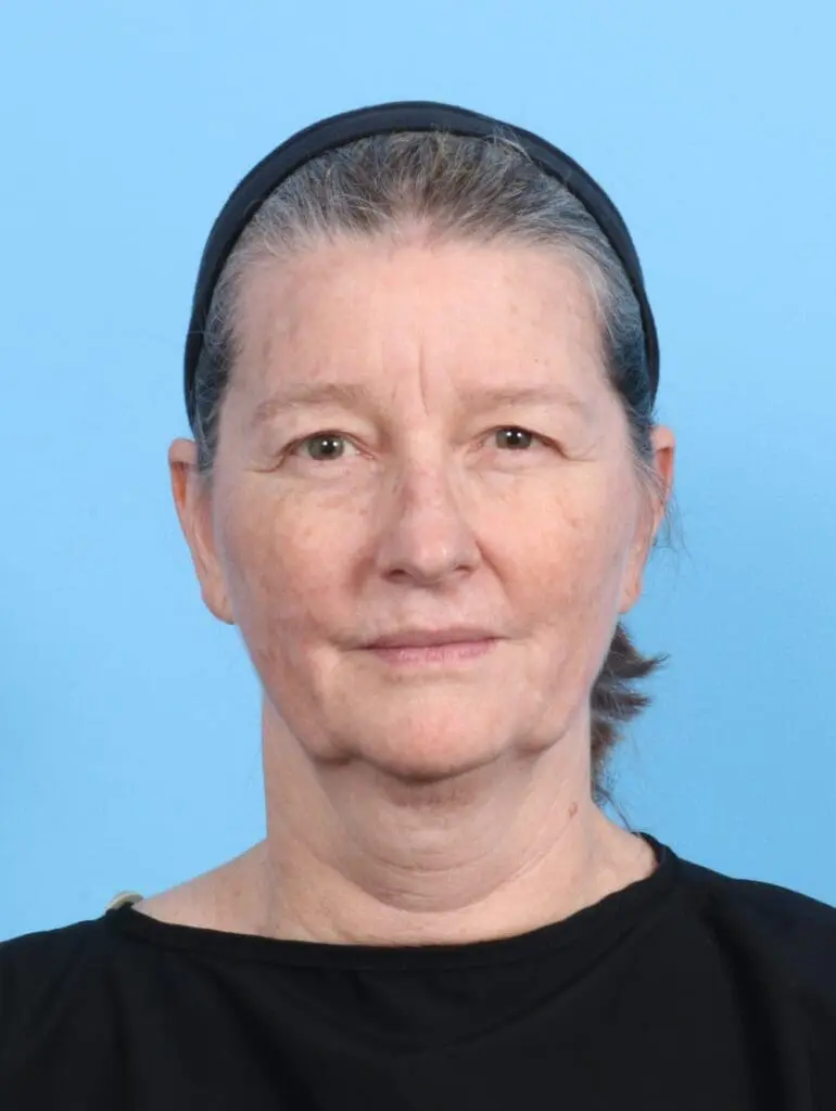 Eyelid Surgery - Case 20036 - Before