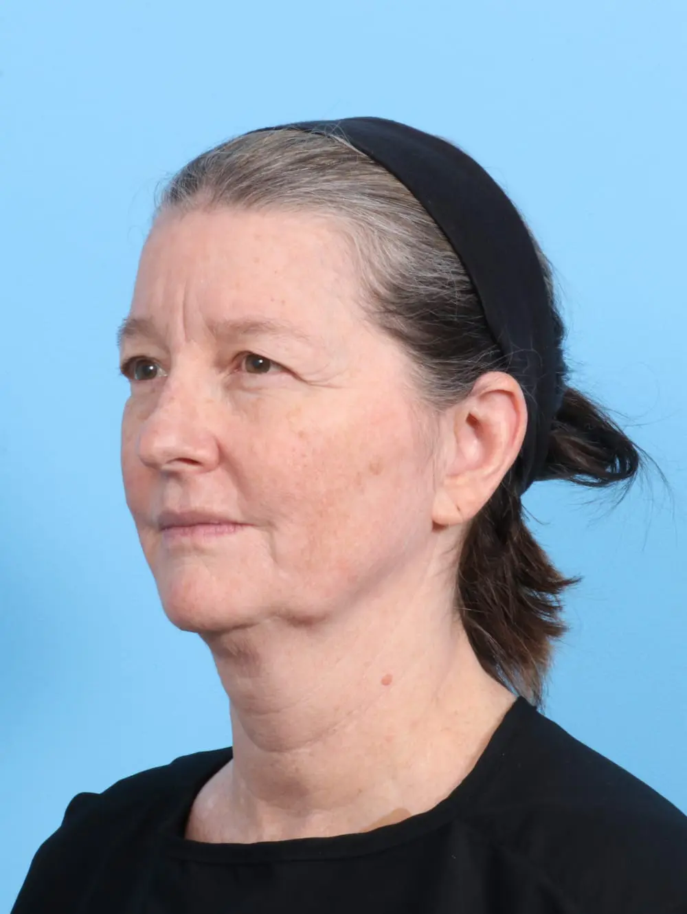 Eyelid Surgery Patient Photo - Case 20036 - before view-1