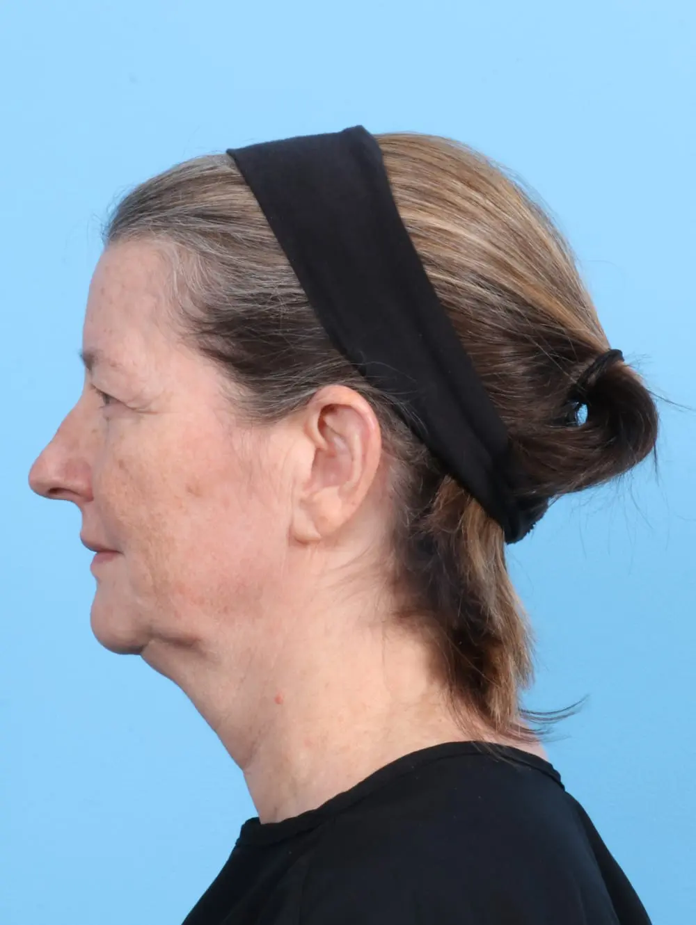 Eyelid Surgery Patient Photo - Case 20036 - before view-2