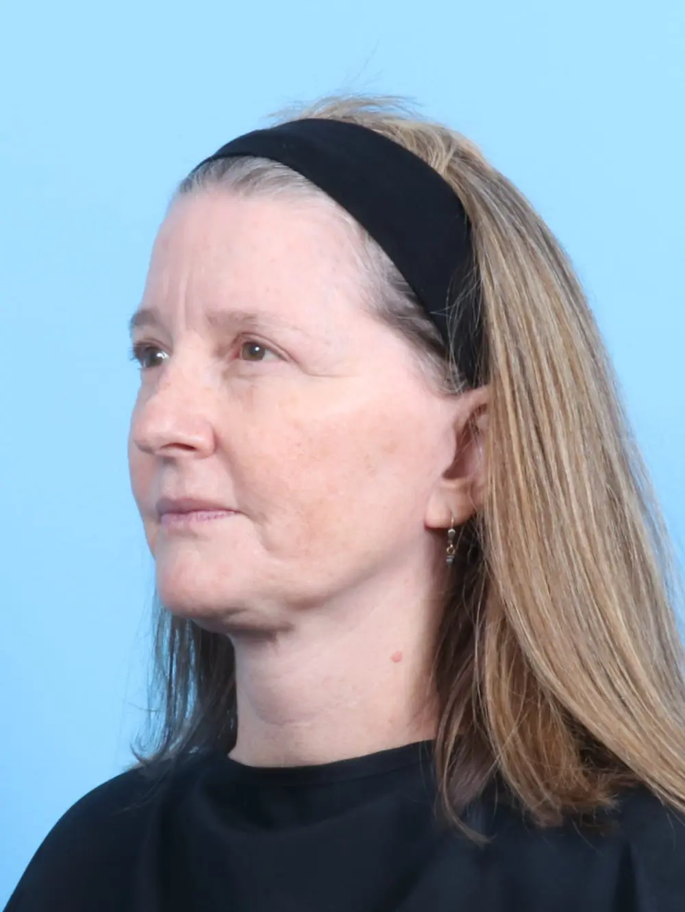 Eyelid Surgery Patient Photo - Case 20036 - after view-1