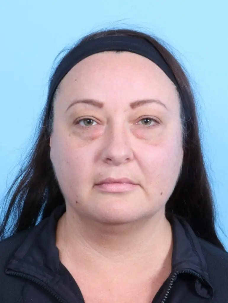 Eyelid Surgery - Case 20045 - Before