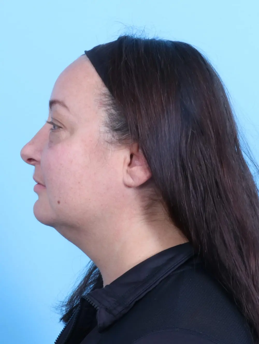 Eyelid Surgery Patient Photo - Case 20045 - before view-2