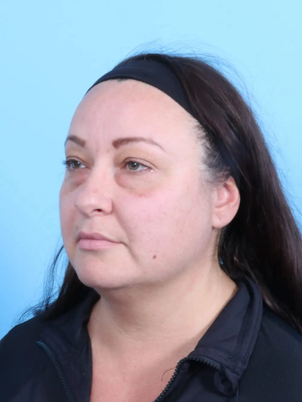 Eyelid Surgery Patient Photo - Case 20045 - before view-1