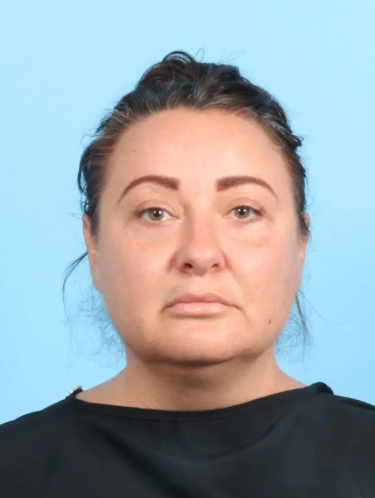 Eyelid Surgery - Case 20045 - After