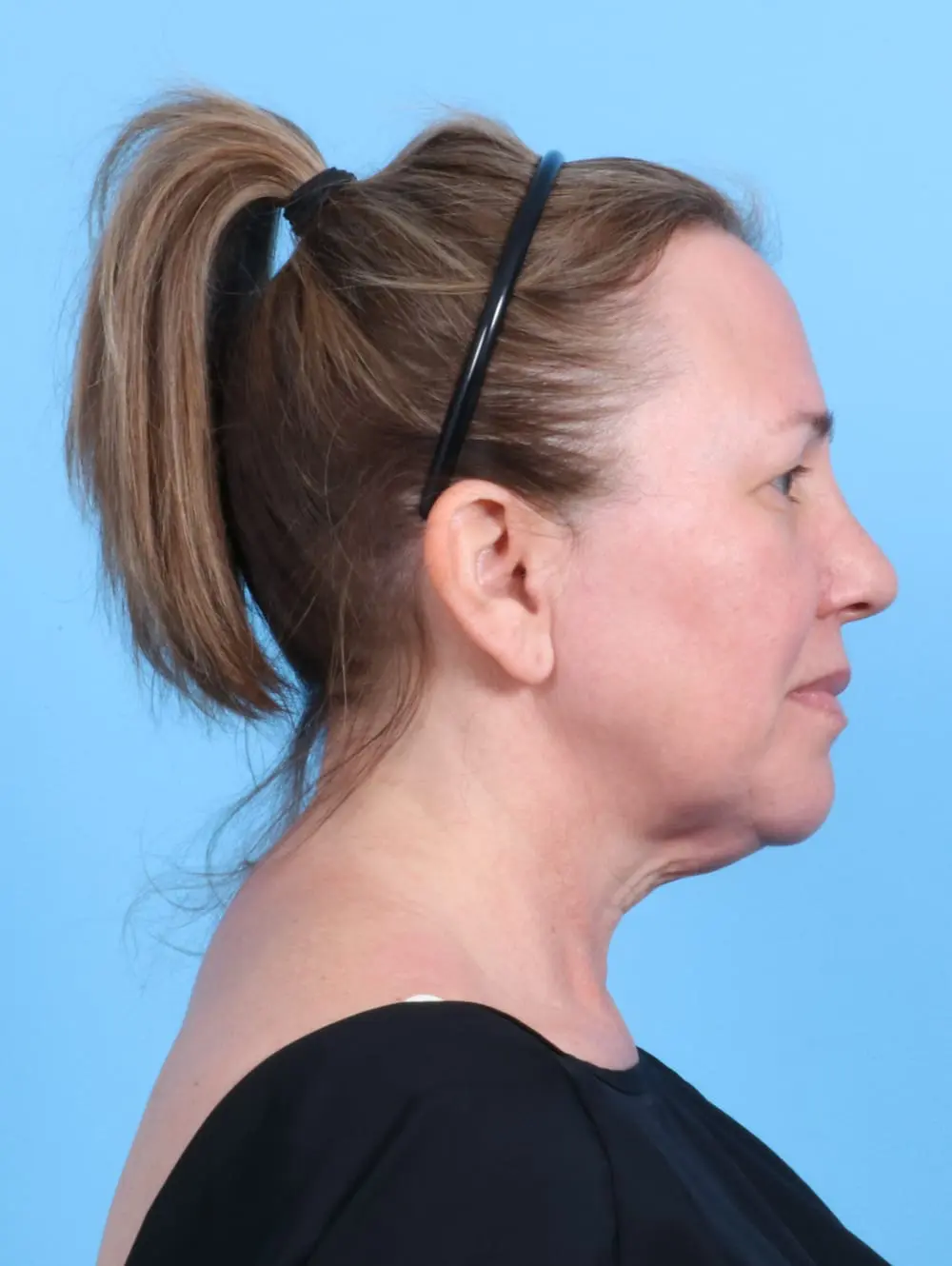 Eyelid Surgery Patient Photo - Case 20177 - before view-2