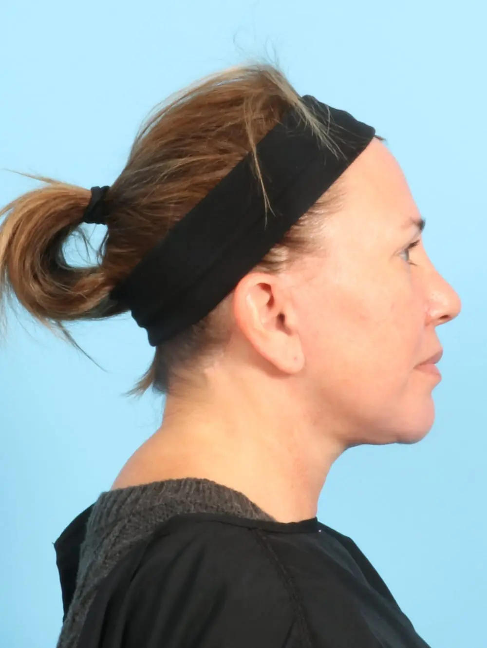 Eyelid Surgery Patient Photo - Case 20177 - after view-2