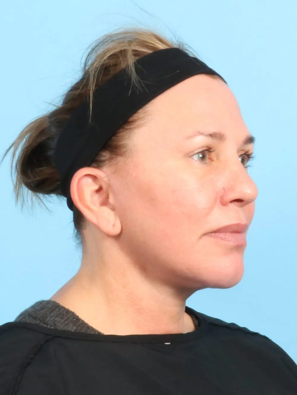 Eyelid Surgery Patient Photo - Case 20177 - after view-1