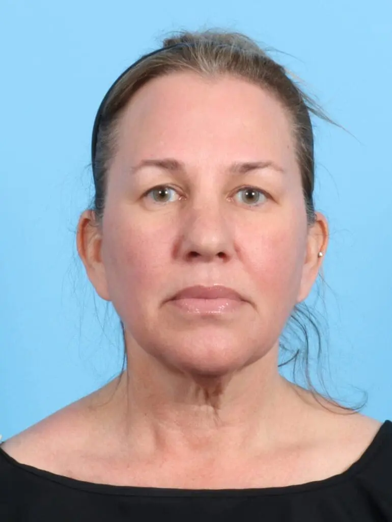 Eyelid Surgery - Case 20177 - Before