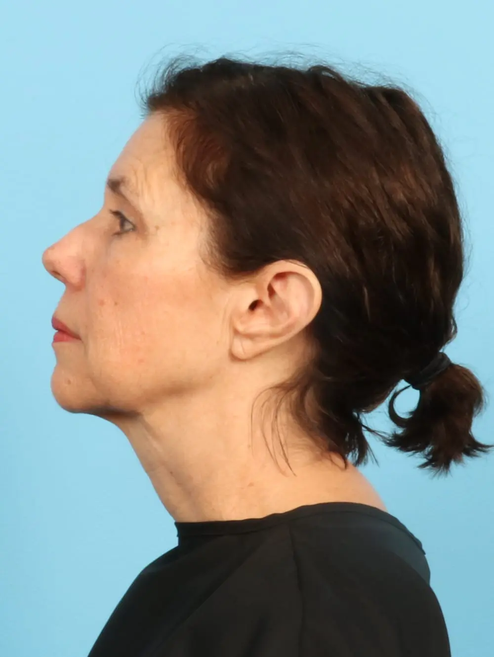 Facelift / Neck Lift Patient Photo - Case 20185 - before view-2