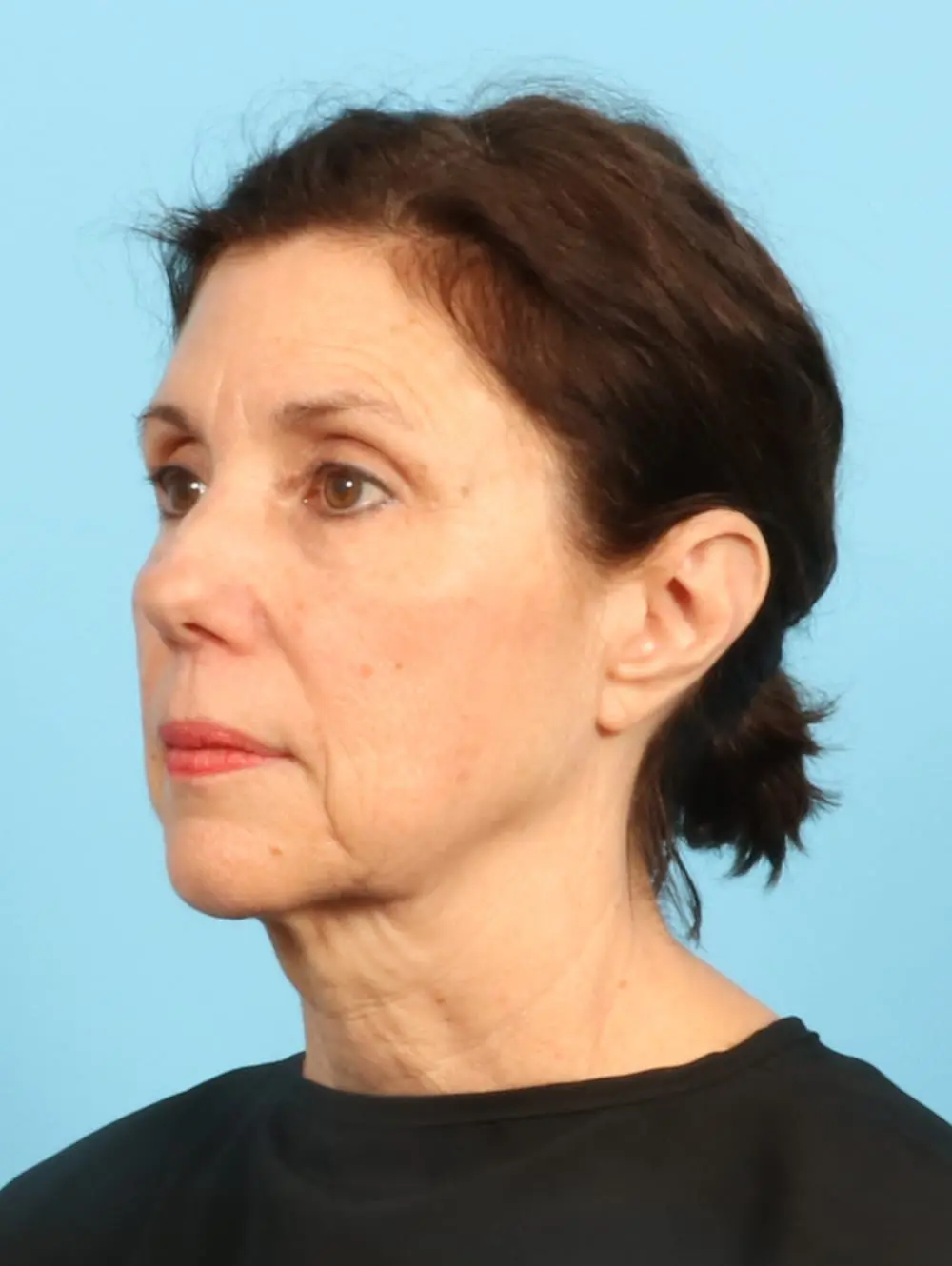 Facelift / Neck Lift Patient Photo - Case 20185 - before view-1