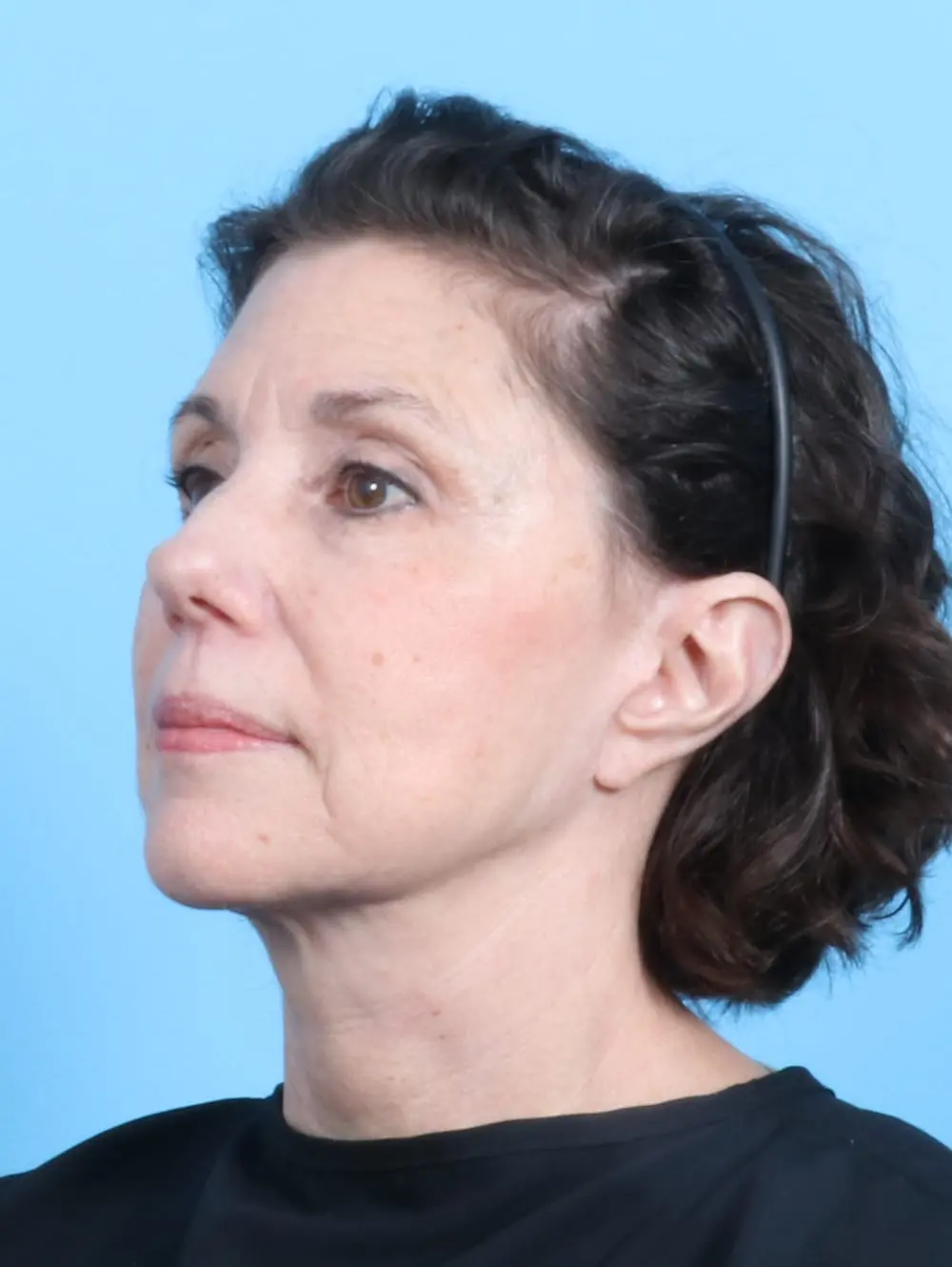 Facelift / Neck Lift Patient Photo - Case 20185 - after view-1
