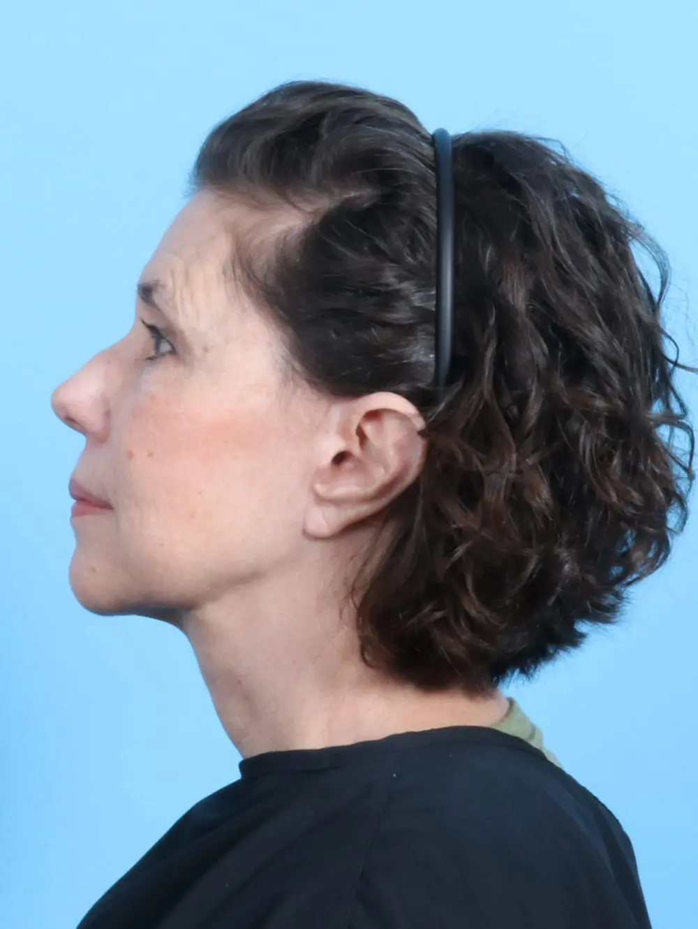 Facelift / Neck Lift Patient Photo - Case 20185 - after view-2