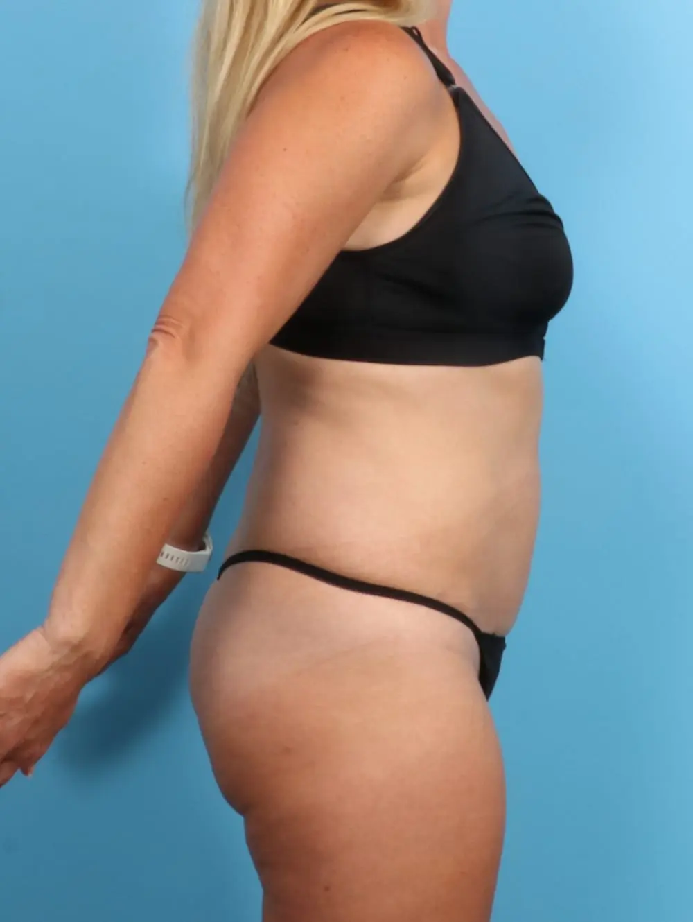 Liposuction Patient Photo - Case 20286 - before view-3